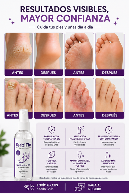 TerbiFin Spray Cuidado Intensivo para Pies y Uñas